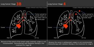 stage 3b and 4 lung cancer