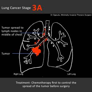 stage 3A lung cancer